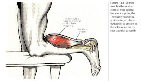 Achilles+tendon+rupture+repair